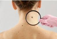 Melanoma Micro-model 3D Printing Service