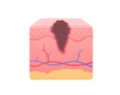 Melanoma Micro-model