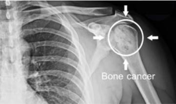 Bone cancer of the shoulder under X-ray.