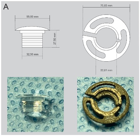 Keratoprosthesis of Brazil design and dimensions. Mushroom-shaped front stem (optical component; left) made of PMMA.( Magalhães OA, et al.; 2022)