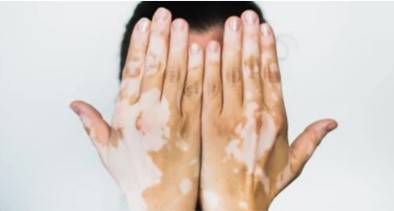 Hands of the patient with vitiligo skin disease.