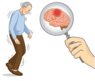 Parkinson's Disease Micro-model 3D Printing Service