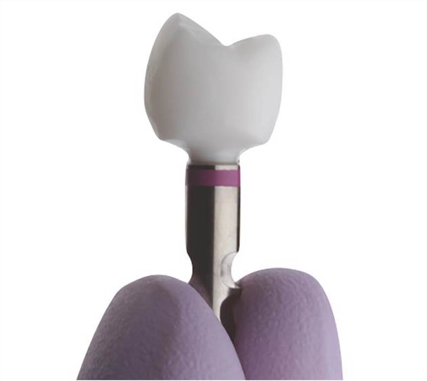 A monolithic tooth crown 3D printed with zirconia material.