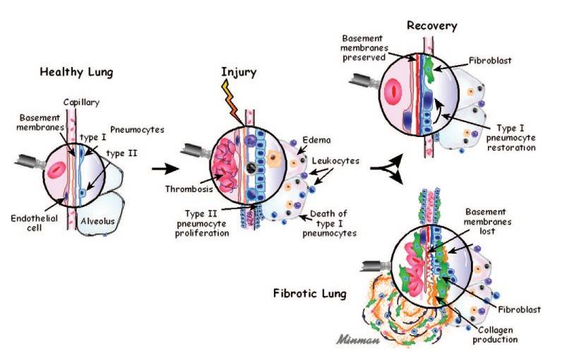 Diagrammatic representation of physiologic and pathologic fibrotic response to lung injury.